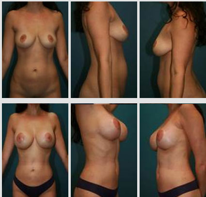 breast-augmentation-11