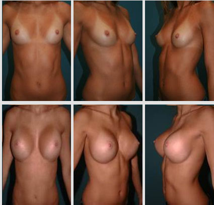 breast-augmentation-01