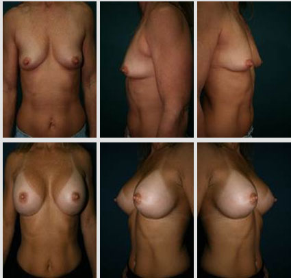 breast-augmentation-02