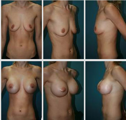 breast-augmentation-03