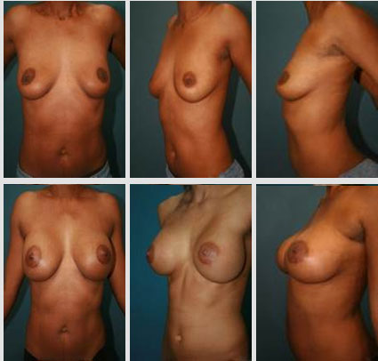 breast-augmentation-05