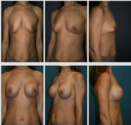 breast-augmentation-09
