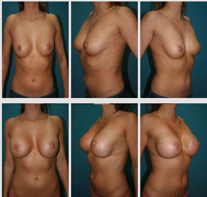 breast-augmentation-10