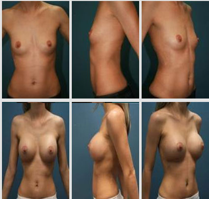 breast-augmentation-13