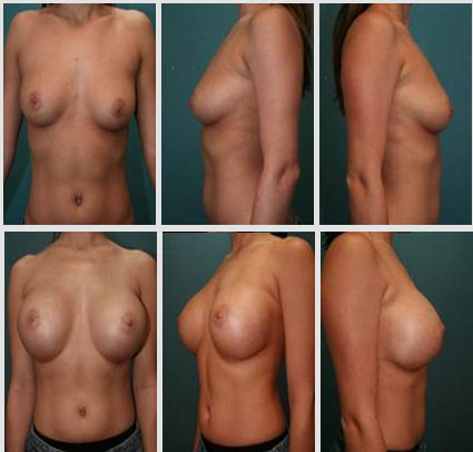 breast-augmentation-15