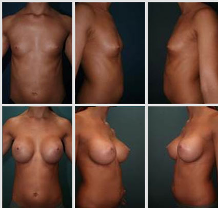 breast-augmentation-17