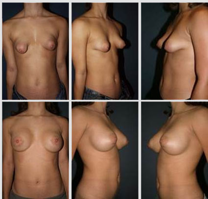 breast-augmentation-18