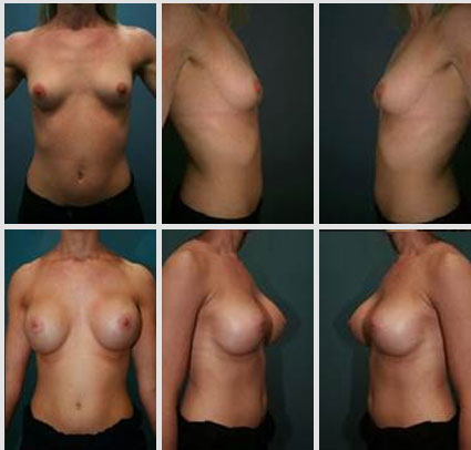 breast-augmentation-19