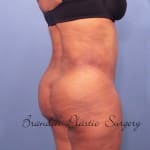 Sensational Brazilian Butt Lift Tampa by leading plastic surgeon Dr. Shienbaum
