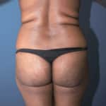 Beautiful Brazilian Butt Lift Clearwater by foremost plastic surgeon Dr. Shienbaum