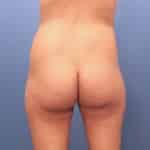 Brazilian Butt Lift Bloomingdale Fishhawk top plastic surgeon Dr. Shienbaum