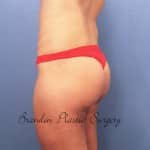 Brazilian Butt Lift Bloomingdale Fishhawk top plastic surgeon Dr. Shienbaum