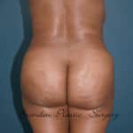 Stunning Clearwater Brazilian Butt Lift of Brandon Plastic Surgery