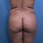 Elite Brazilian Butt Lift Lakeland by premiere plastic surgeon Dr. Shienbaum