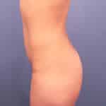 Intriging Bradenton Brazilian Butt Lift by foremost plastic surgeon of Brandon Plastic Surgery
